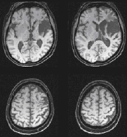 structural magnetic resonance imaging